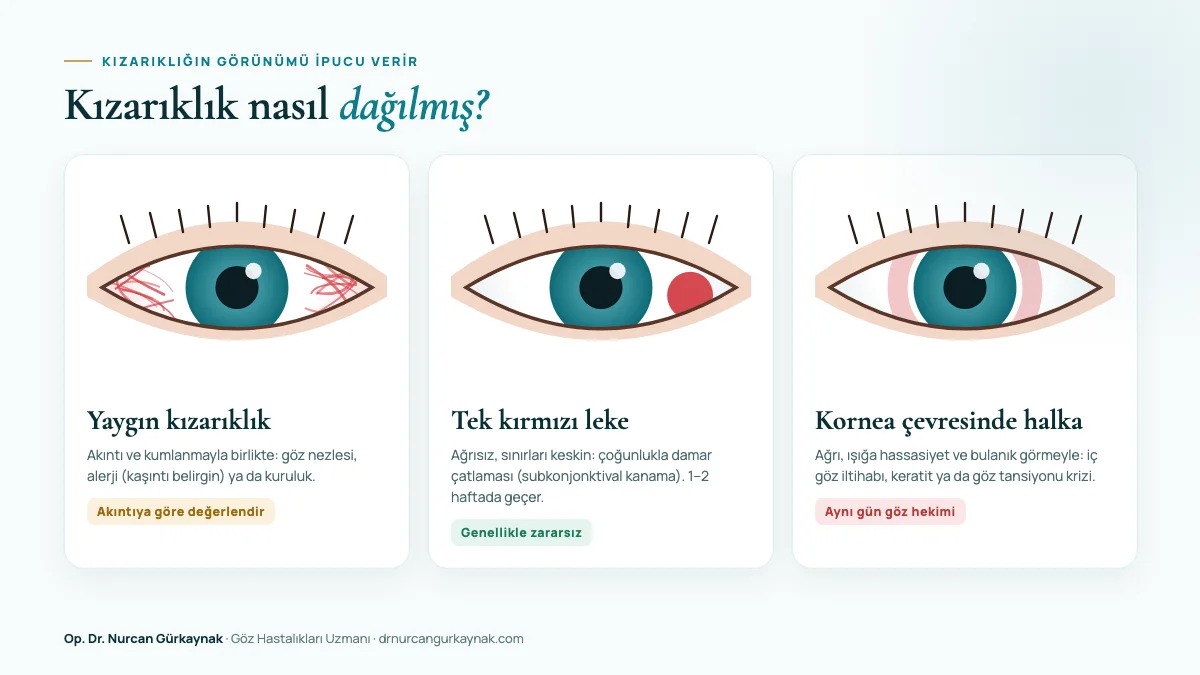 Göz kızarıklığının görünüm haritası: yaygın kızarıklık, kırmızı leke ve kornea çevresinde halka şeklinde kızarıklık